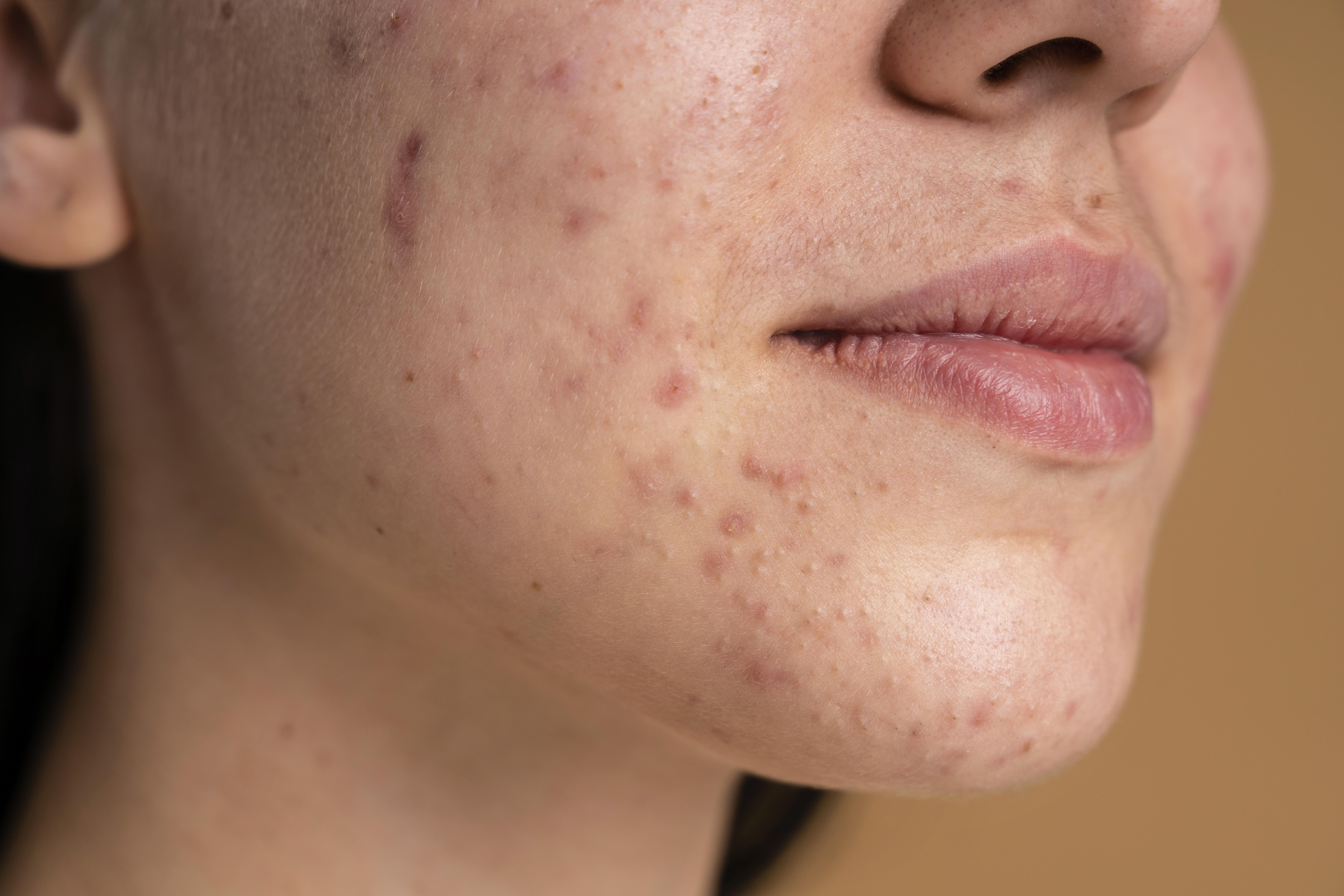 confident young woman with acne close up confident young woman with acne close up