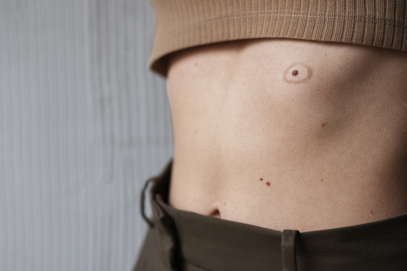 woman with melanoma her skin woman with melanoma her skin